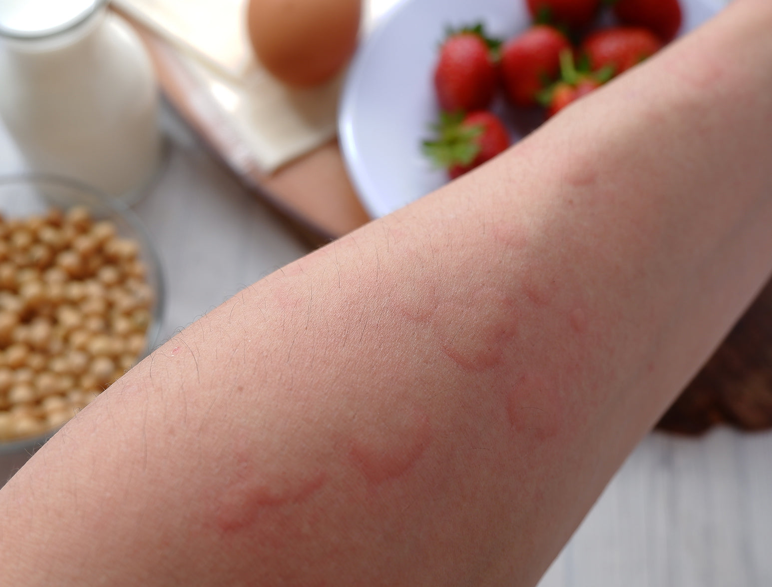 Alergias , intolerancias  y sensibilidad alimentaria. En qué se diferencian